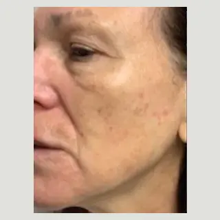 A woman with brown spots on her face.