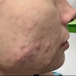 A woman with acne scars on her face.