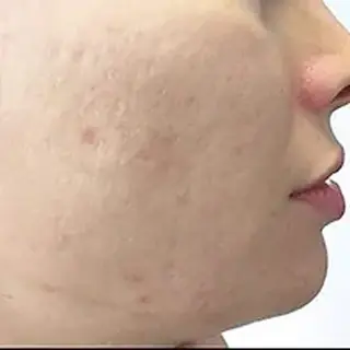 A woman with acne on her face and chin.