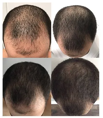 A man 's head with different stages of hair loss.