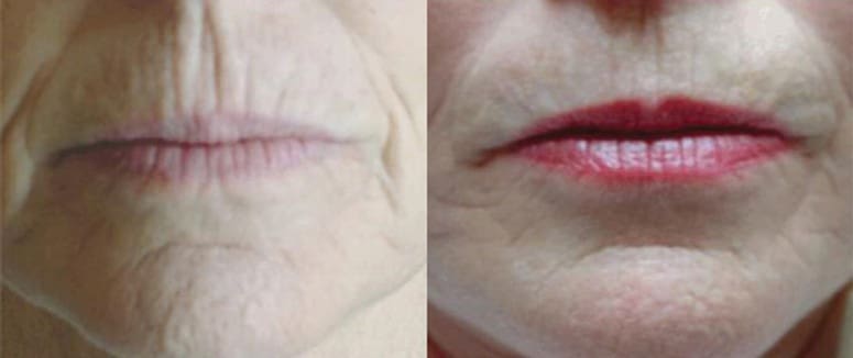 A before and after picture of the lips of an older woman.